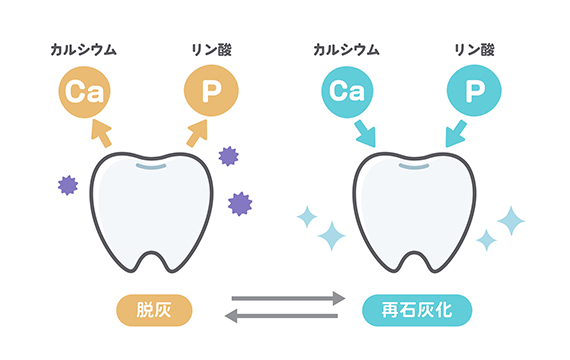 虫歯の原因と虫歯ができる仕組み