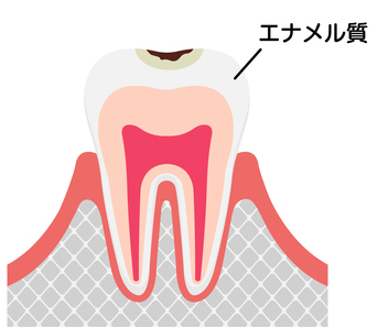 C1（初期の虫歯）の症状・治療法