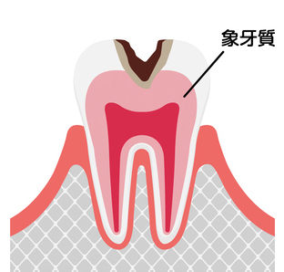 C2（進行し始めた虫歯）の症状・治療法