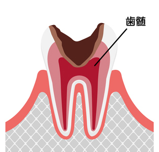 C3（神経にまで進行した虫歯）の症状・治療法
