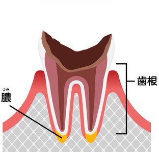 C4（ほとんど歯質残っていない虫歯）の症状・治療法