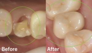 渋谷マロン歯科Tokyo｜【症例】難症例を抜歯即時インプラント治療で審美的に改善｜ビフォーアフター