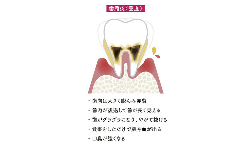 渋谷マロン歯科Tokyo｜糖尿病と歯周病の密接な関係　健康な歯を保つために知っておくべきこと｜重度の歯周炎の画像と説明