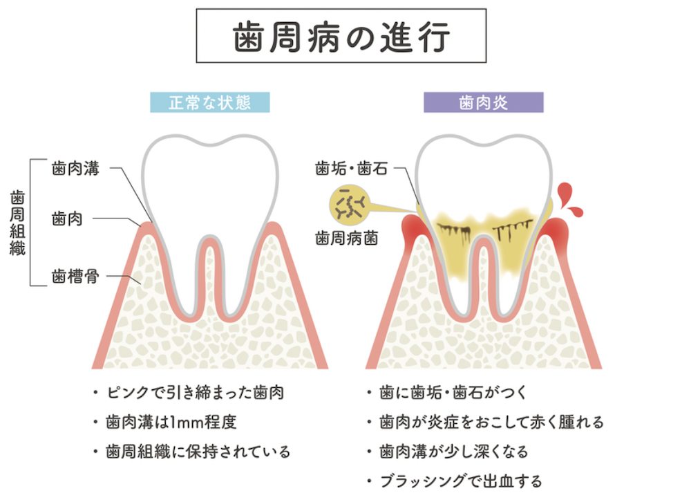 渋谷マロン歯科Tokyo｜糖尿病と歯周病の密接な関係　健康な歯を保つために知っておくべきこと｜歯周病の進行、正常な状態と歯肉炎の状態の画像と説明