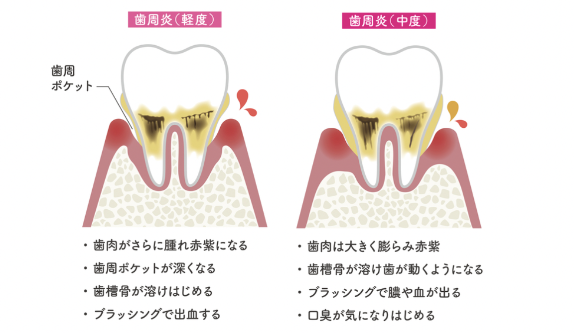 渋谷マロン歯科Tokyo｜糖尿病と歯周病の密接な関係　健康な歯を保つために知っておくべきこと｜軽度、中度の歯周炎のイメージ画像と説明