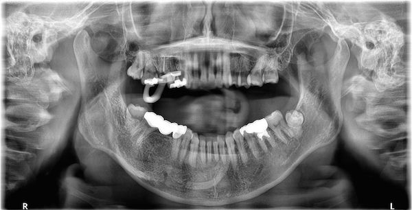 渋谷マロン歯科Tokyo｜【症例】歯科恐怖症の方に対する短期集中治療×無痛治療の全顎的な治療｜術前レントゲンの画像