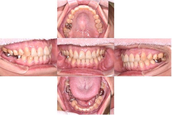 渋谷マロン歯科Tokyo｜【症例】歯科恐怖症の方に対する短期集中治療×無痛治療の全顎的な治療｜術前の口腔内の画像