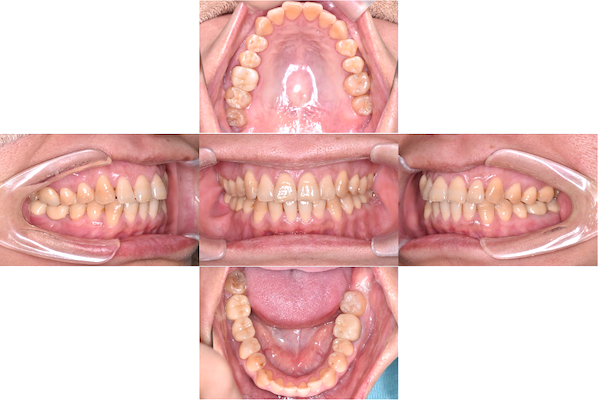 【症例】歯科恐怖症の方に対する短期集中治療×無痛治療の全顎的な治療
