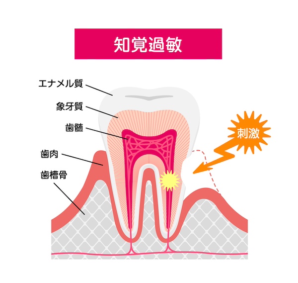 歯の断面の説明画像｜知覚過敏の原因と治療法 冷たい食べ物・飲み物がしみる原因｜渋谷マロン歯科Tokyo