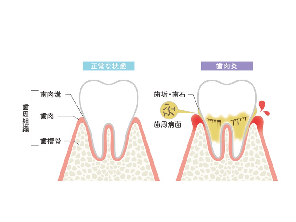 歯肉炎の初期症状：早期治療で健康な歯茎を取り戻す｜渋谷マロン歯科Tokyo｜正常な歯肉と歯肉炎の図解