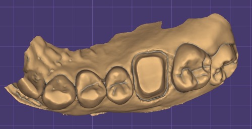 デジタル歯科ソフトexocad®の画像2｜セラミック治療とは？美しさと耐久性を両立する最新の治療法｜渋谷マロン歯科Tokyo