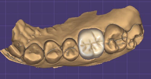 デジタル歯科ソフトexocad®の画像1｜セラミック治療とは？美しさと耐久性を両立する最新の治療法｜渋谷マロン歯科Tokyo