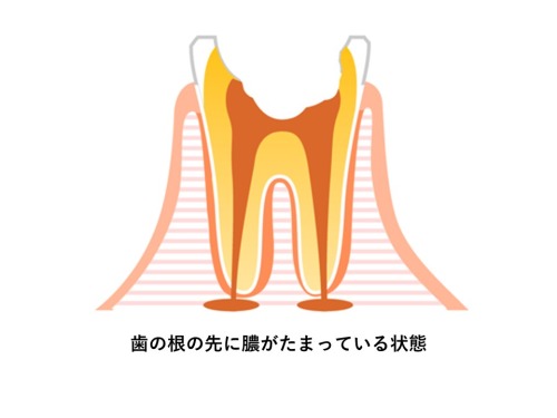 歯の根の先に膿が溜まってる歯のイラスト｜根管治療とは？治療の流れと根管治療の重要性｜渋谷マロン歯科Tokyo