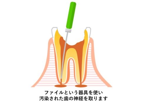 歯の神経を取るイラスト｜根管治療とは？治療の流れと根管治療の重要性｜渋谷マロン歯科Tokyo