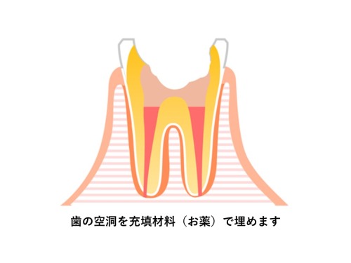 歯の根っこにお薬を詰めたイラスト｜根管治療とは？治療の流れと根管治療の重要性｜渋谷マロン歯科Tokyo