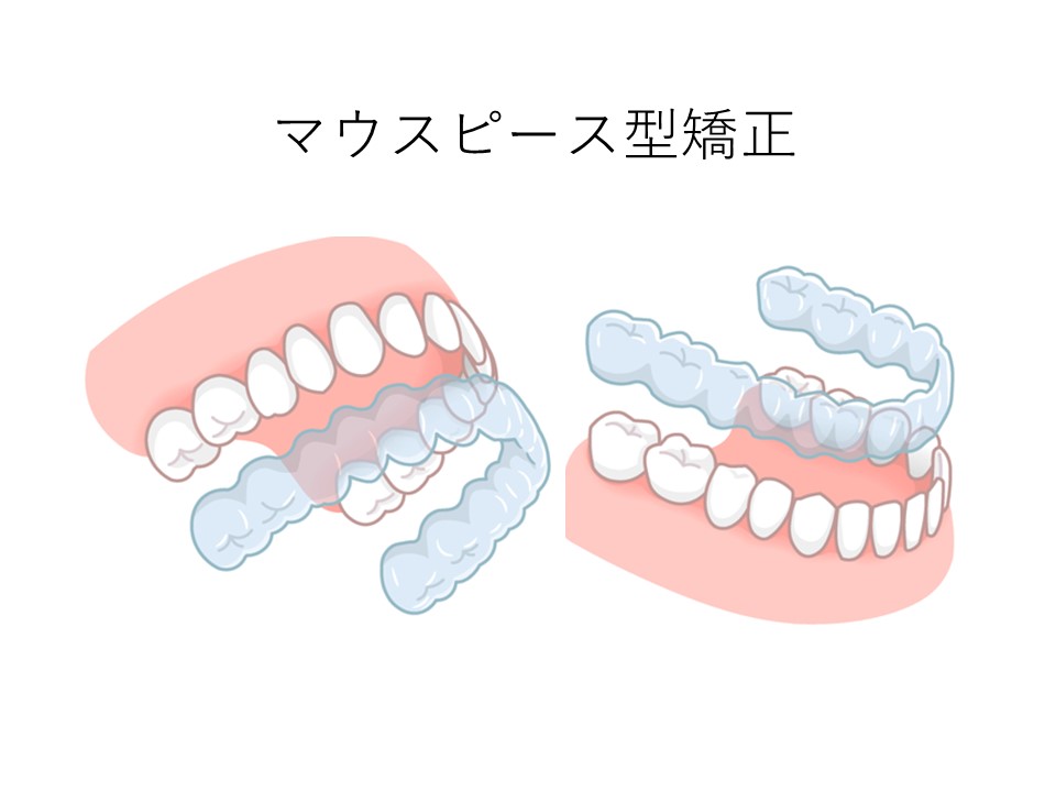 マウスピース型矯正装置のイラスト｜矯正歯科で美しい歯並びを手に入れるには？よくある疑問に回答！｜渋谷マロン歯科Tokyo