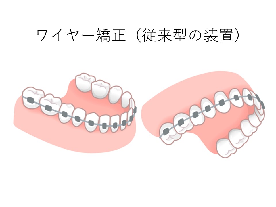 ワイヤー矯正（従来型の装置）のイラスト｜矯正歯科で美しい歯並びを手に入れるには？よくある疑問に回答！｜渋谷マロン歯科Tokyo