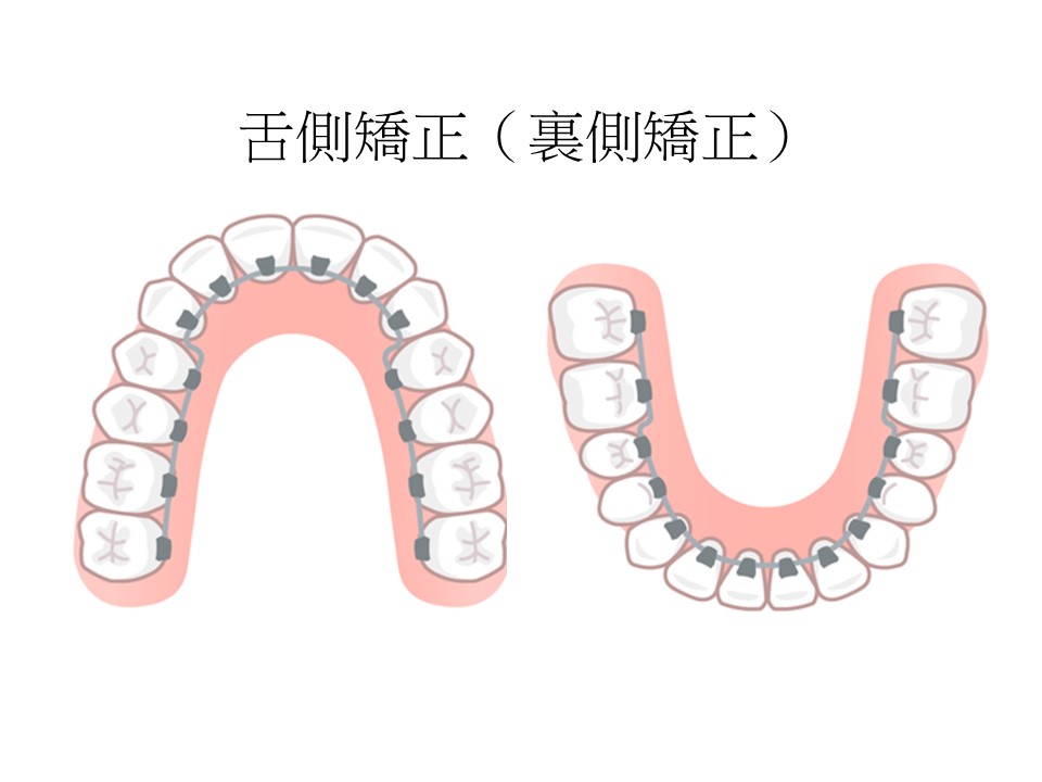 舌側矯正のイラスト｜矯正歯科で美しい歯並びを手に入れるには？よくある疑問に回答！｜渋谷マロン歯科Tokyo