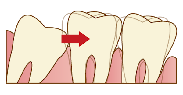 斜めに生えて隣の歯を押す親知らずのイメージ画像｜親知らずは抜歯した方が良い？痛みや腫れとリスク、治療の流れを解説｜渋谷マロン歯科Tokyo