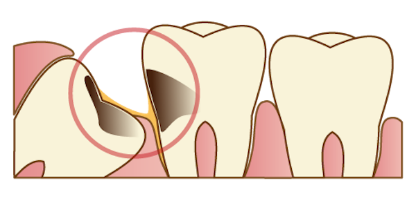 隣の歯と虫歯を引き起こす親知らずのイメージ画像｜親知らずは抜歯した方が良い？痛みや腫れとリスク、治療の流れを解説｜渋谷マロン歯科Tokyo