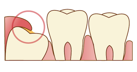 歯茎に埋もれて生える親知らずのイメージ画像｜親知らずは抜歯した方が良い？痛みや腫れとリスク、治療の流れを解説｜渋谷マロン歯科Tokyo