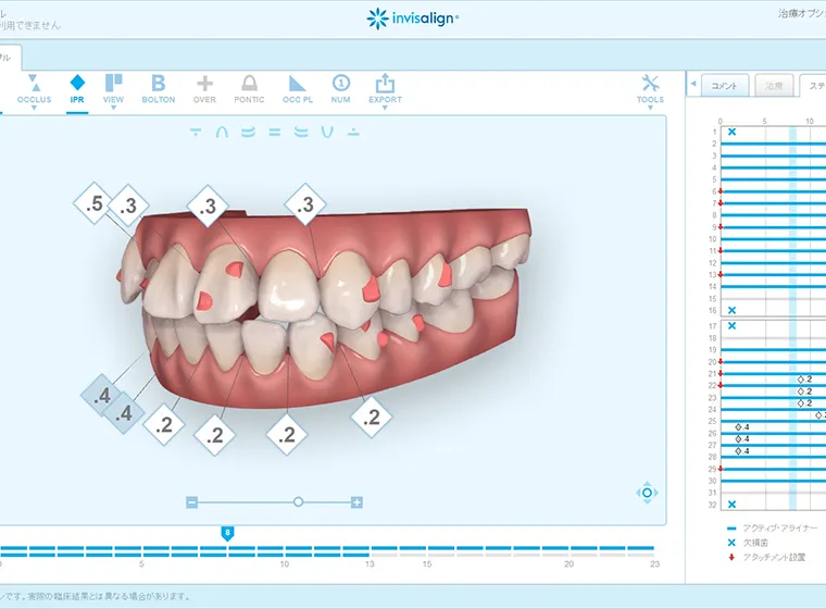 インビザラインでの矯正治療時のシミュレーションイメージ｜渋谷マロン歯科Tokyo