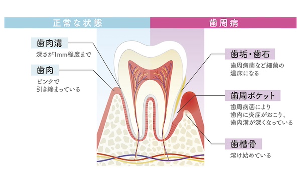 健康な歯と歯周病の歯の比較画像｜知っておきたい「歯周病の症状と予防法」進行度別の治療法も解説｜渋谷マロン歯科Tokyo