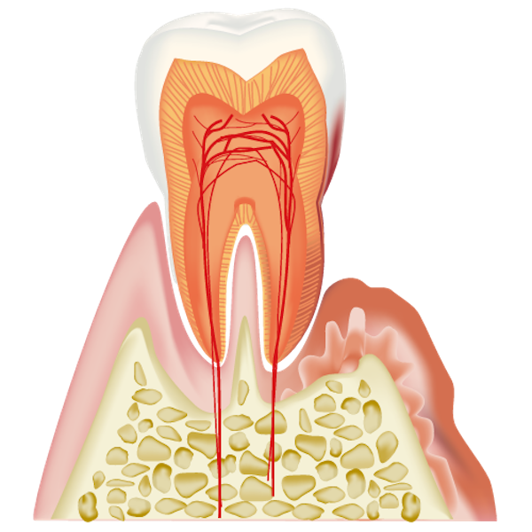 軽度歯周炎の歯と歯茎の画像｜知っておきたい「歯周病の症状と予防法」進行度別の治療法も解説｜渋谷マロン歯科Tokyo