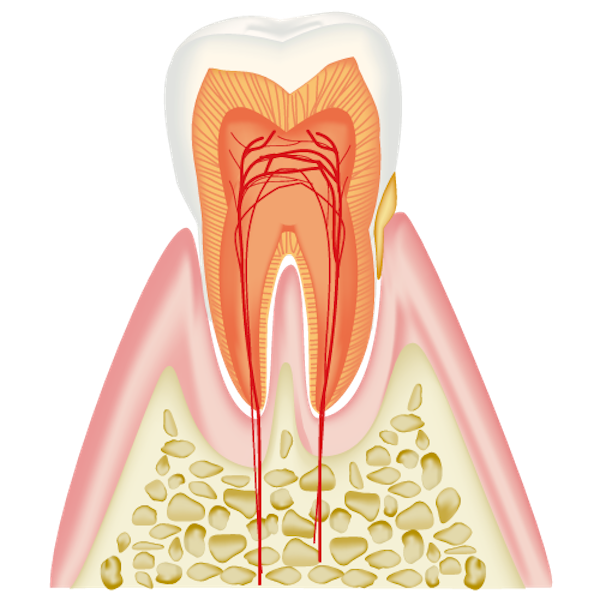 歯肉炎の歯と歯茎の画像｜知っておきたい「歯周病の症状と予防法」進行度別の治療法も解説｜渋谷マロン歯科Tokyo
